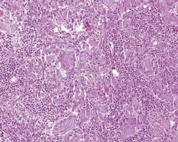 Fig 12. Histología de una reacción granulomatosa a material de relleno